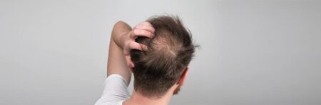 Alopecia